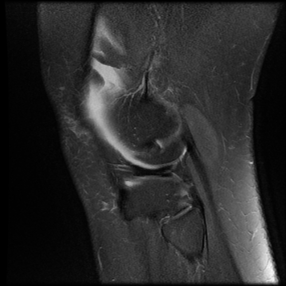 File:Anterior cruciate ligament tear, Wrisberg rip and bucket-handle tear of medial meniscus (Radiopaedia 75872-87266 Sagittal PD fat sat 4).jpg