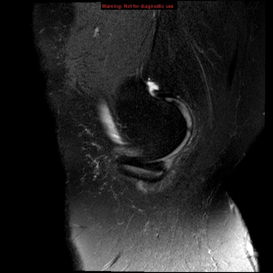 File:Anterior cruciate ligament tear (Radiopaedia 12329-12612 E 19).jpg