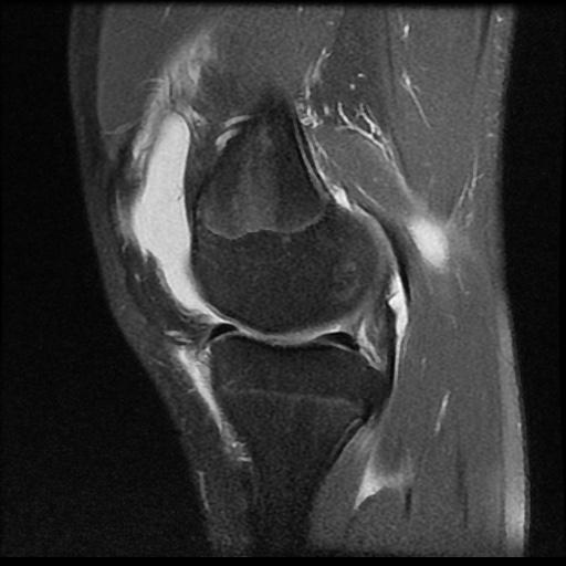 File:Anterior cruciate ligament tear (Radiopaedia 61500-69462 Sagittal PD fat sat 6).jpg