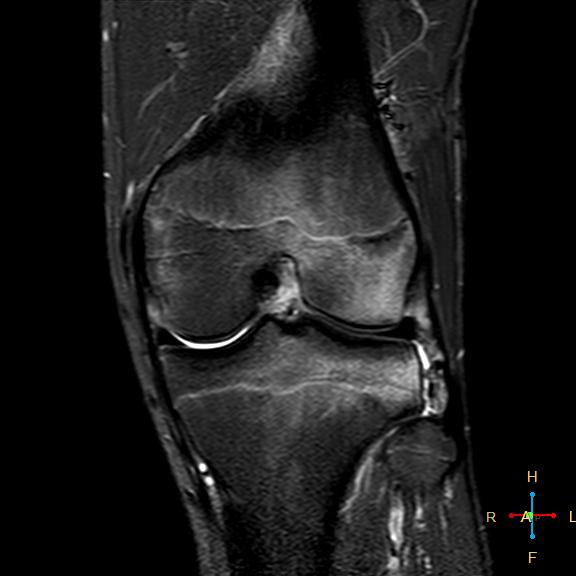 File:Anterior cruciate ligament tear - complete (Radiopaedia 24907-25170 Coronal STIR 12).jpg