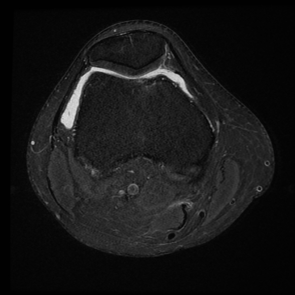 File:Anterior cruciate ligament tear with posteromedial corner injury, bucket-handle meniscal tear and chondral delamination (Radiopaedia 75501-86744 Axial PD fat sat 19).jpg