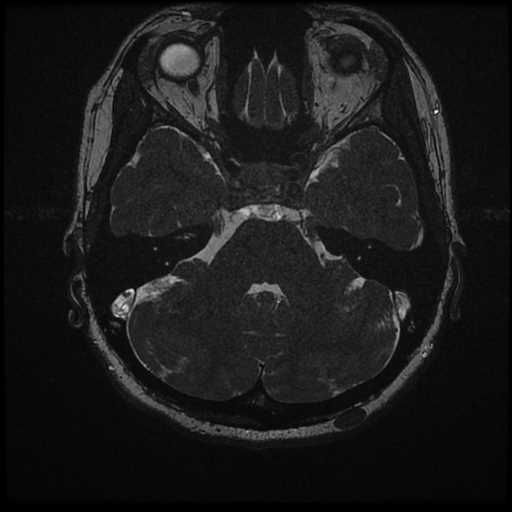 Anterior inferior cerebellar artery vascular loop - type II (Radiopaedia 70991-81209 Axial 3D FIESTA 24).jpg