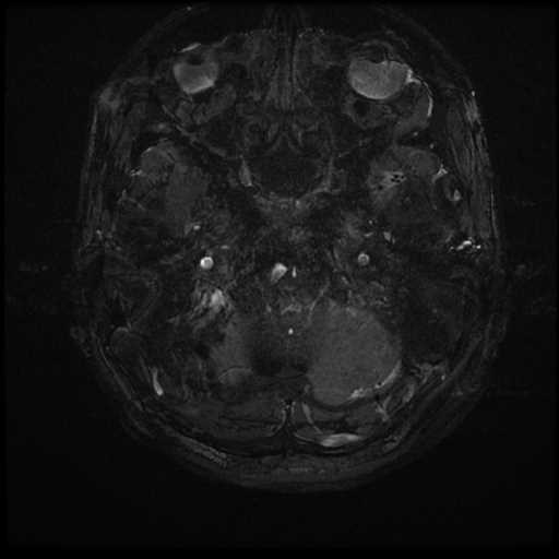 Anterior inferior cerebellar artery vascular loop - type II (Radiopaedia 70991-81209 Axial 3D FIESTA 83).jpg