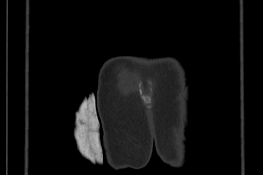 Anterior inferior iliac spine avulsion injury (Radiopaedia 88666-105376 Coronal bone window 72).jpg