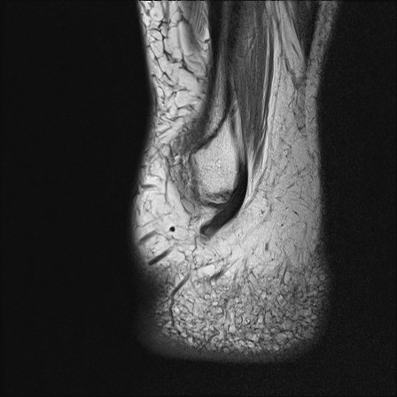 File:Anterior talofibular ligament injury - rupture with soft-tissue impingement (Radiopaedia 38765-40928 Sagittal PD 19).jpg