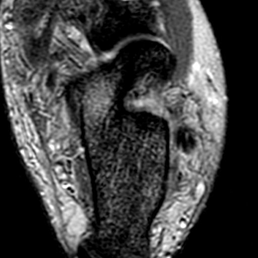 File:Anterior talofibular ligament rupture (Radiopaedia 15831-15484 Axial T2* 17).jpg
