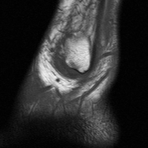 File:Anterior talofibular ligament rupture (Radiopaedia 15831-15484 Sagittal T1 2).jpg