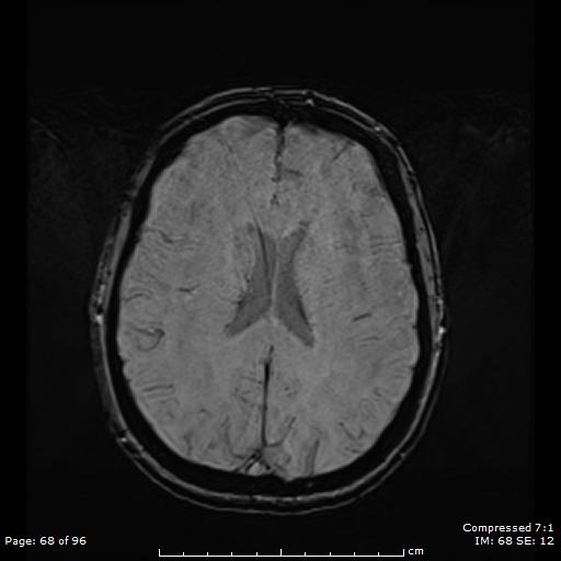 File:Anterior temporal lobe perivascular space (Radiopaedia 88283-104914 Axial SWI 37).jpg