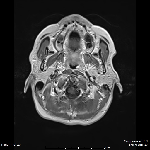 File:Anterior temporal lobe perivascular space (Radiopaedia 88283-104914 Axial T1 C+ 4).jpg