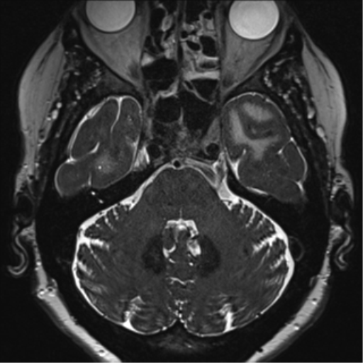 Anterior temporal pole cysts (Radiopaedia 46629-51102 Axial 13).png