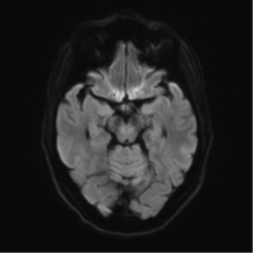 Anterior temporal pole cysts (Radiopaedia 46629-51102 Axial DWI 38).png