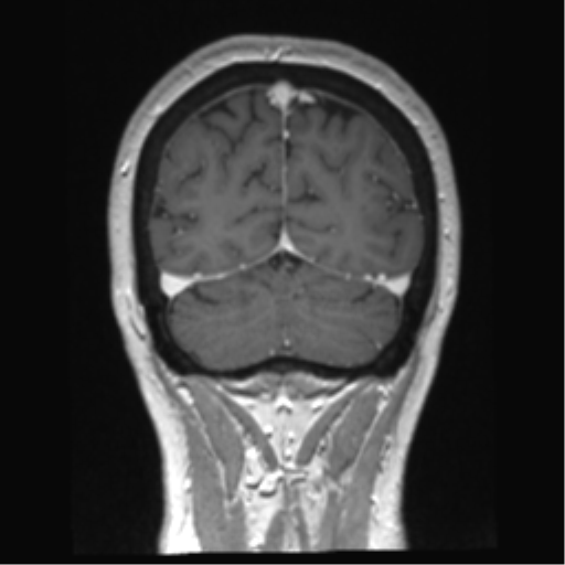 Anterior temporal pole cysts (Radiopaedia 46629-51102 Coronal T1 C+ 36).png