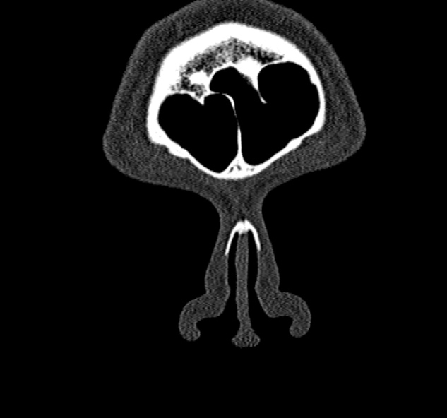 File:Antrochoanal polyp (Radiopaedia 30002-30554 Coronal bone window 7).jpg