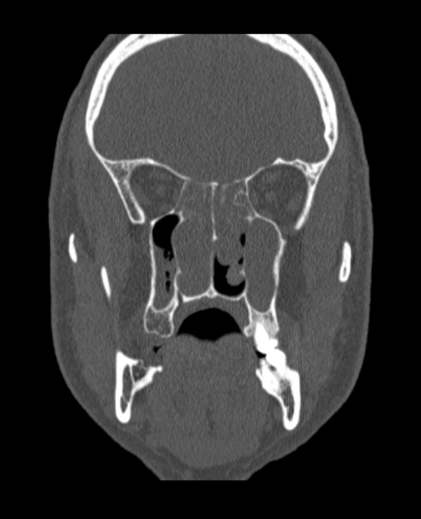 Antrochoanal polyp (Radiopaedia 79011-92169 Coronal bone window 40).jpg