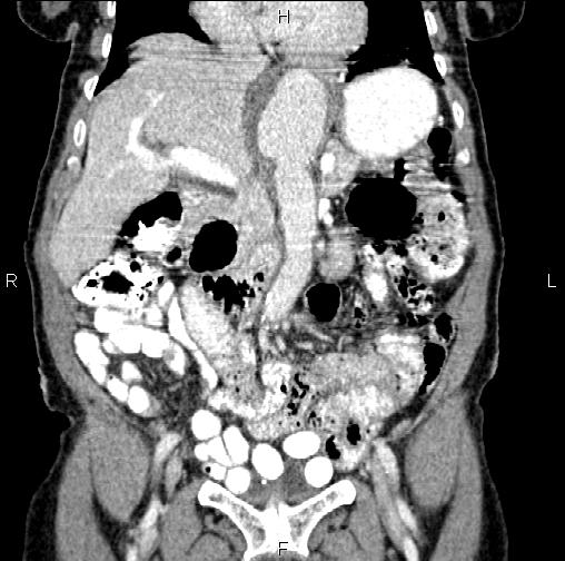 Aortic aneurysm and Lemmel syndrome (Radiopaedia 86499-102554 C 23).jpg