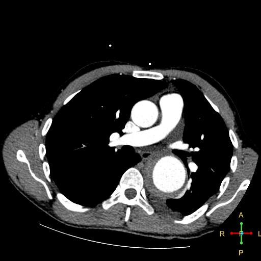 File:Aortic aneurysm and penetrating ulcer (Radiopaedia 23590-23704 A 16).jpg