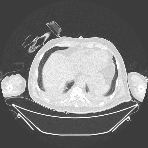Aortic arch aneurysm (Radiopaedia 84109-99365 Axial lung window 227).jpg