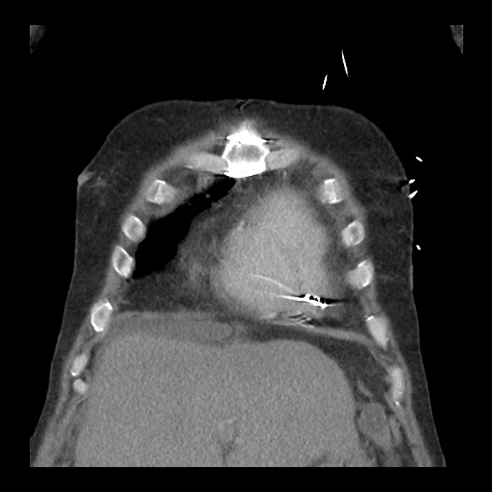 Aortic arch graft infection (FDG PET-CT) (Radiopaedia 71975-82437 Coronal 13).jpg