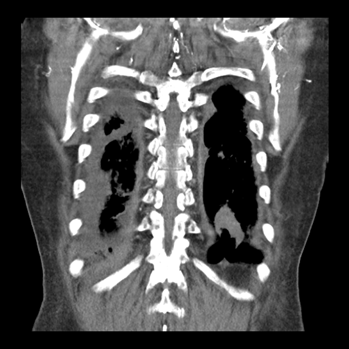 Aortic arch graft infection (FDG PET-CT) (Radiopaedia 71975-82437 Coronal 51).jpg