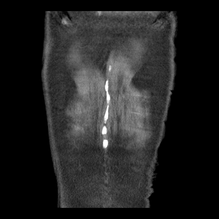 Aortic arch graft infection (FDG PET-CT) (Radiopaedia 71975-82437 Coronal 58).jpg