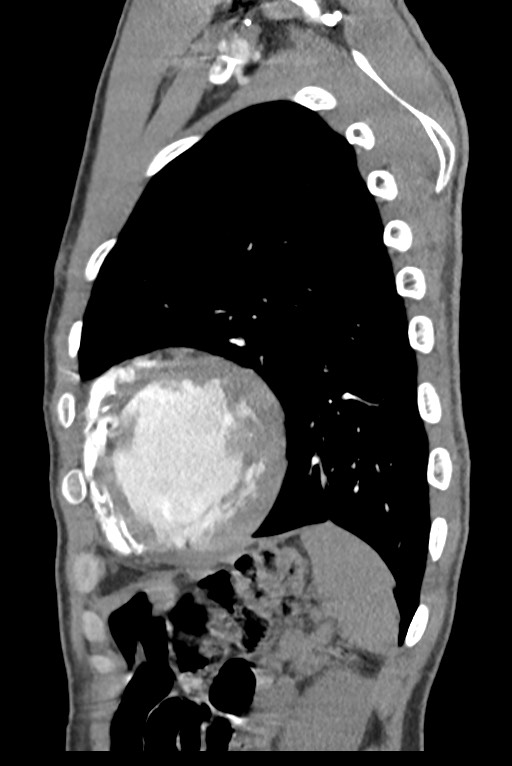 Aortic coarctation with aneurysm (Radiopaedia 74818-85828 B 129).jpg