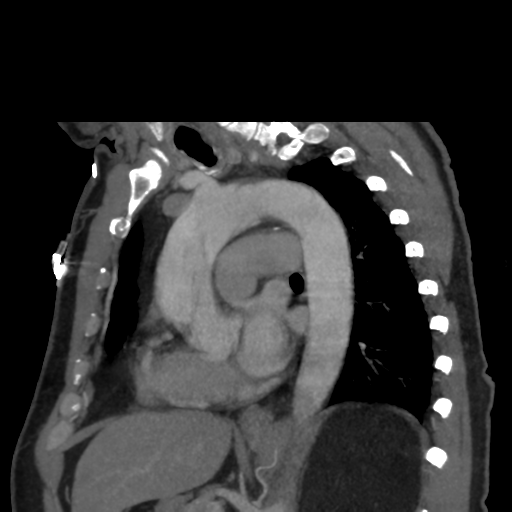 File:Aortic dissection- Stanford A (Radiopaedia 37759-39664 D 17).png