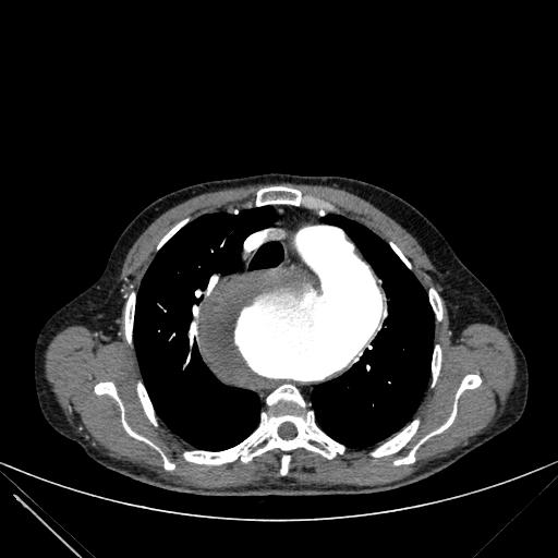 Aortic dissection (Radiopaedia 27466-27665 C+ arterial phase 54).jpg