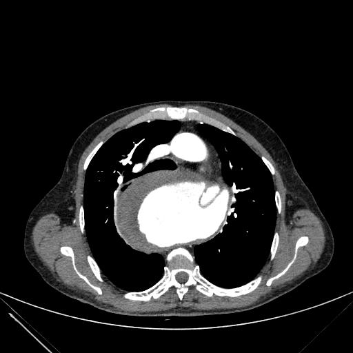 Aortic dissection (Radiopaedia 27466-27665 C+ arterial phase 81).jpg