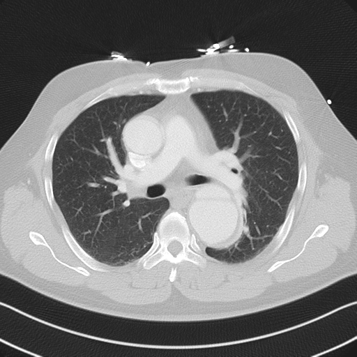 File:Aortic dissection (Radiopaedia 50763-56234 Axial lung window 31).png