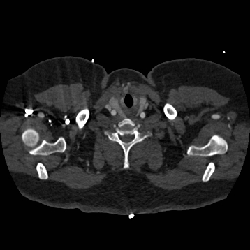 Aortic dissection (Radiopaedia 57969-64959 A 5).jpg