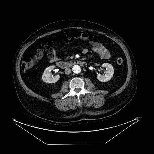 Aortic dissection (Radiopaedia 62562-71000 A 68).jpg
