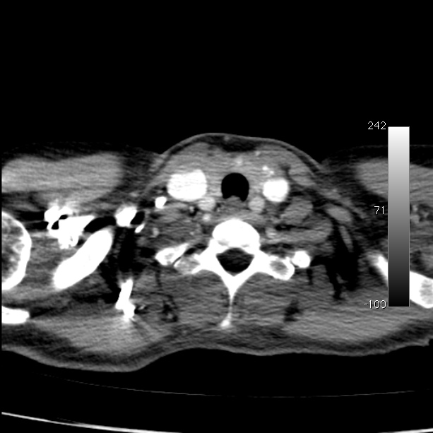 Aortic dissection - Stanford type A (Radiopaedia 29247-29659 A 5).jpg
