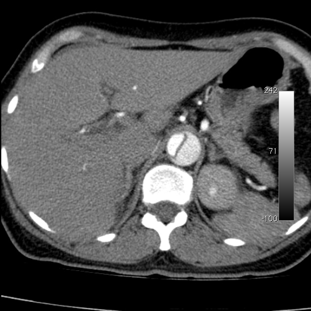Aortic dissection - Stanford type A (Radiopaedia 29247-29659 A 76).jpg