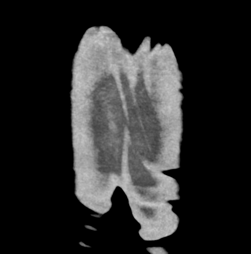 File:Aortic dissection - Stanford type B (Radiopaedia 50171-55512 B 87).png
