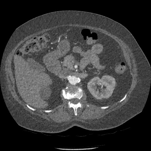 Aortic dissection - Stanford type B (Radiopaedia 88281-104910 A 112).jpg