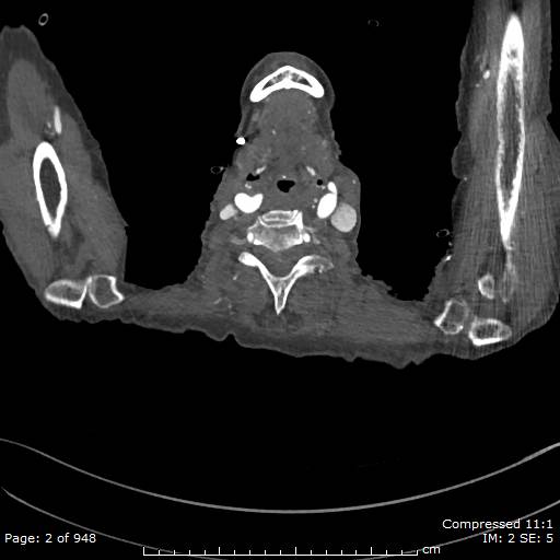 Aortic dissection with extension into aortic arch branches (Radiopaedia 64402-73204 B 2).jpg