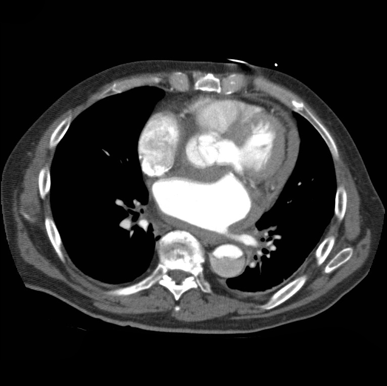 Aortic dissection with rupture into pericardium (Radiopaedia 12384-12647 A 34).jpg