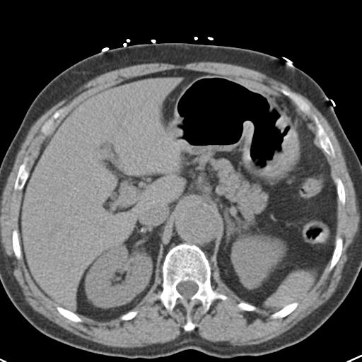 Aortic intramural hematoma (Radiopaedia 31139-31838 Axial non-contrast 53).jpg