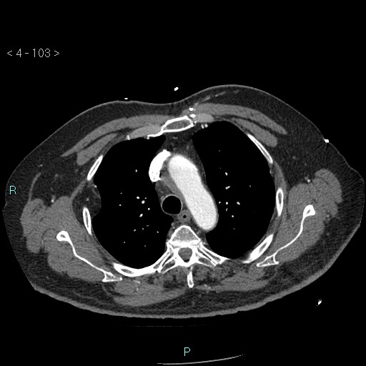 File:Aortic intramural hematoma (Radiopaedia 48463-53380 B 47).jpg