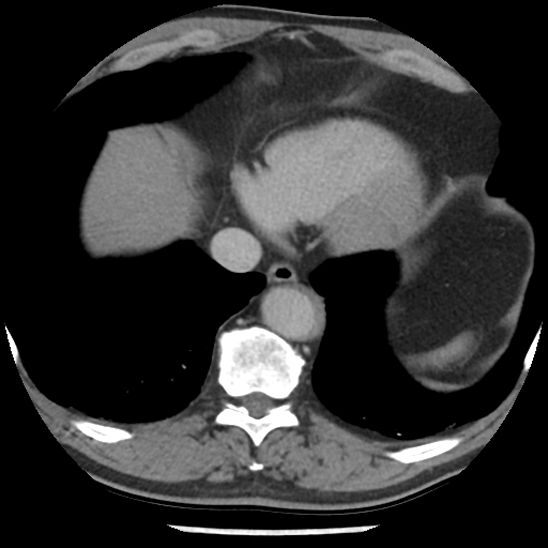 File:Aortic intramural hematoma (type B) (Radiopaedia 79323-92387 Axial C+ delayed 44).jpg