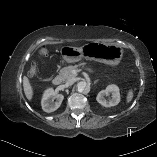 Aortic intramural hematoma with dissection and intramural blood pool (Radiopaedia 77373-89491 E 20).jpg