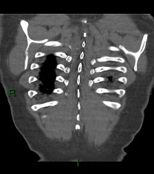 File:Aortic valve endocarditis (Radiopaedia 87209-103485 D 8).jpg