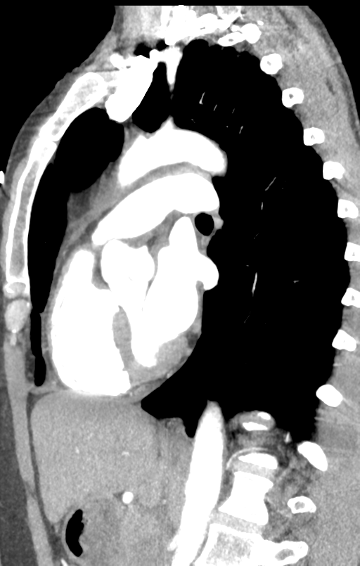 Aortic valve non-coronary cusp thrombus (Radiopaedia 55661-62189 C+ arterial phase 25).png