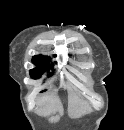 Aortic valve non-coronary cusp thrombus (Radiopaedia 55661-62189 C 11).png