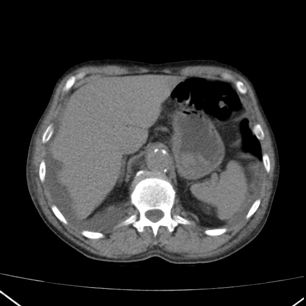 Aortoiliac occlusive disease (Radiopaedia 32134-33076 Axial non-contrast 10).jpg