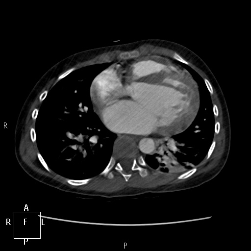 File:Aortopulmonary septal defect (Radiopaedia 41990-45013 Axial C+ CTPA 21).jpg