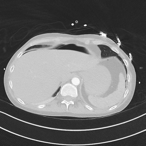 Apical bullous disease in a heavy smoker (Radiopaedia 33067-34092 Axial lung window 54).png