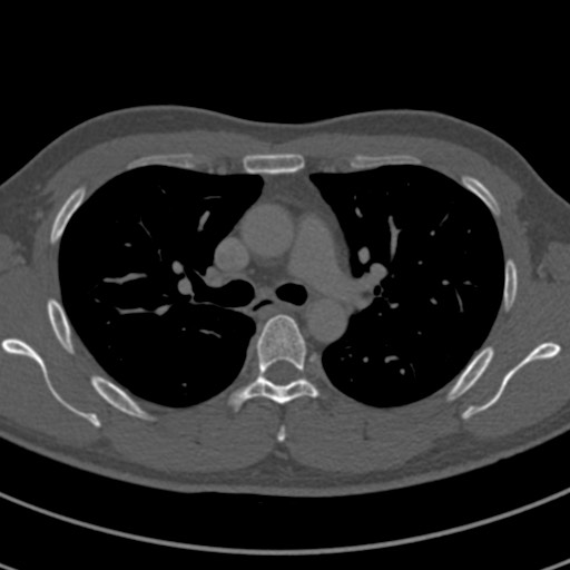 File:Apical lung mass mimic - neurogenic tumor (Radiopaedia 59918-67521 Axial bone window 32).jpg