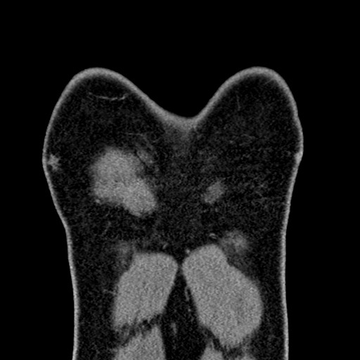 Apical lung mass mimic - neurogenic tumor (Radiopaedia 59918-67521 B 29).jpg