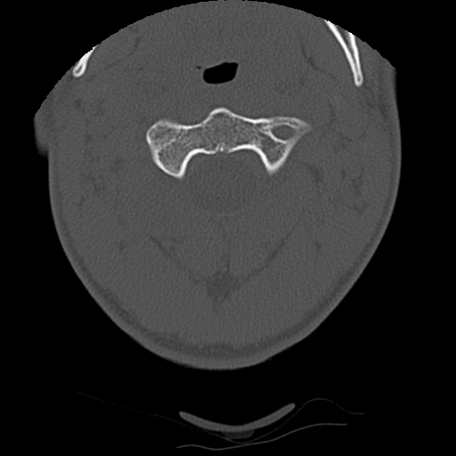 File:Apical pneumothorax on cervical spine CT (Radiopaedia 45343-49368 Axial bone window 22).jpg